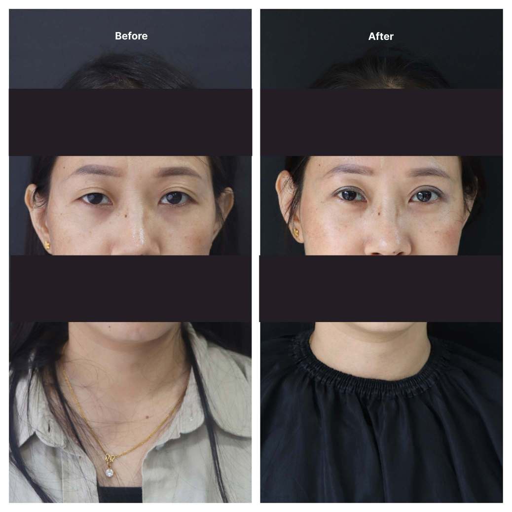 Eyelid Surgery KOQ10